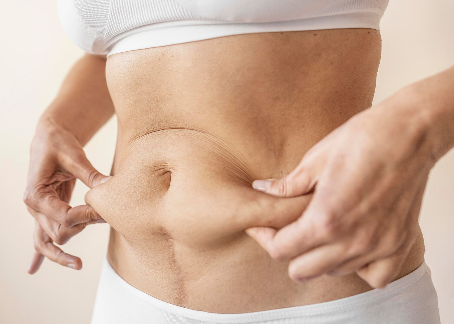 Imagen de una mujer. pinzando la grase de su abdomen con sus manos. La mujer lleva ropa interior blanca. No se le ve la cara ni las piernas